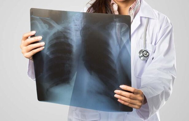 Καρκίνος πνεύμονα: Ο απρόσμενος παράγοντας που αυξάνει τον κίνδυνο 13