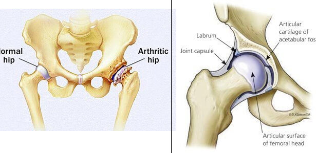 Γιατί Αρθροπλαστική Ισχίου με την μέθοδο AMIS; 23