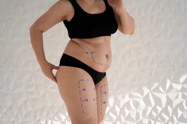 Bikini Ready με Λιποαναρρόφηση Κοιλιάς: Οι πιο Σύγχρονες Τεχνικές για Αφαίρεση Λίπους σε Προσιτό Κόστος 47