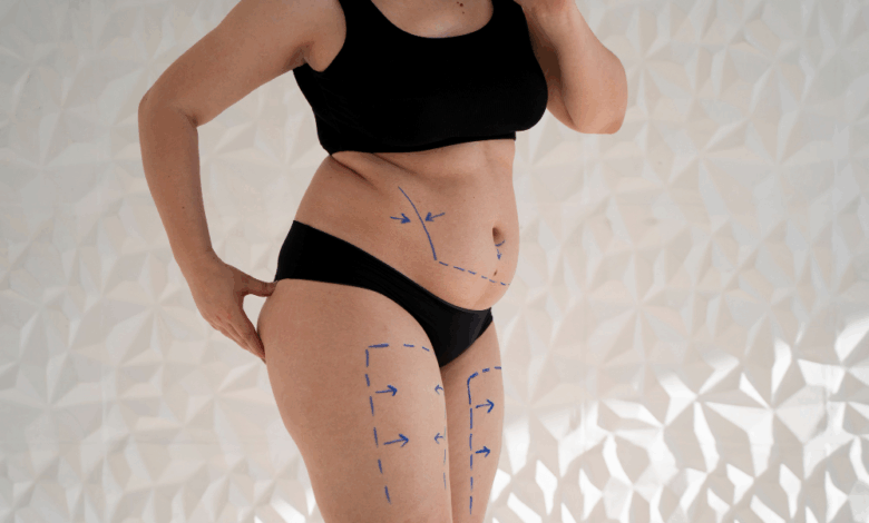 Bikini Ready με Λιποαναρρόφηση Κοιλιάς: Οι πιο Σύγχρονες Τεχνικές για Αφαίρεση Λίπους σε Προσιτό Κόστος 2 Bikini Ready με Λιποαναρρόφηση Κοιλιάς: Οι πιο Σύγχρονες Τεχνικές για Αφαίρεση Λίπους σε Προσιτό Κόστος 1