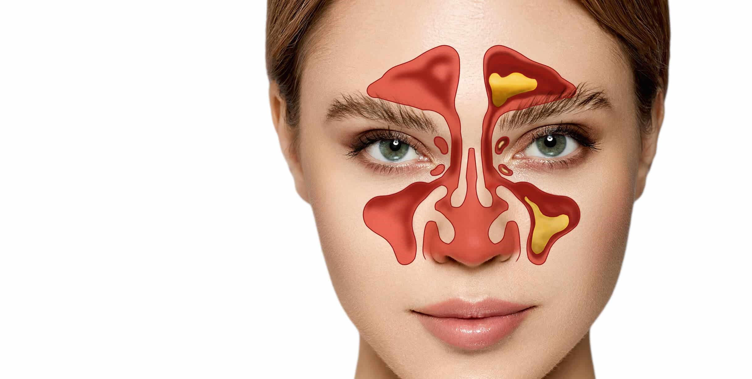 Οξεία και χρόνια ιγμορίτιδα: Αντιμετώπιση με συντηρητική θεραπεία ή εγχείρηση; 3 ιγμορίτιδα