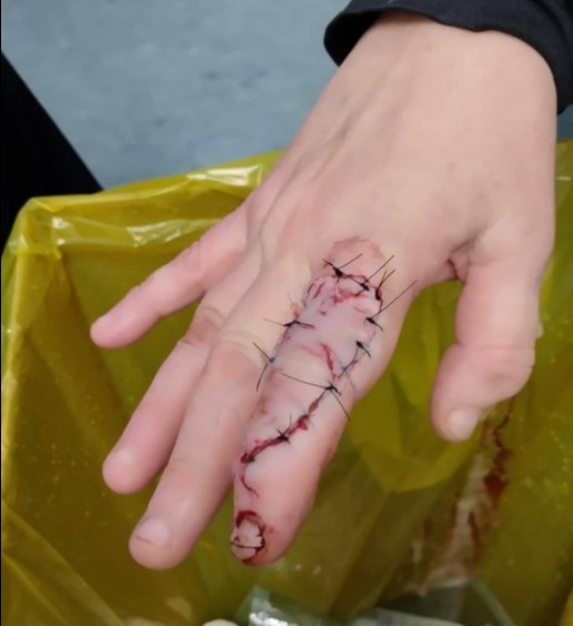 Τραυματισμός εργαζόμενης από σκύλο στο Κέντρο Περίθαλψης Ζώων του Σχιστού 3